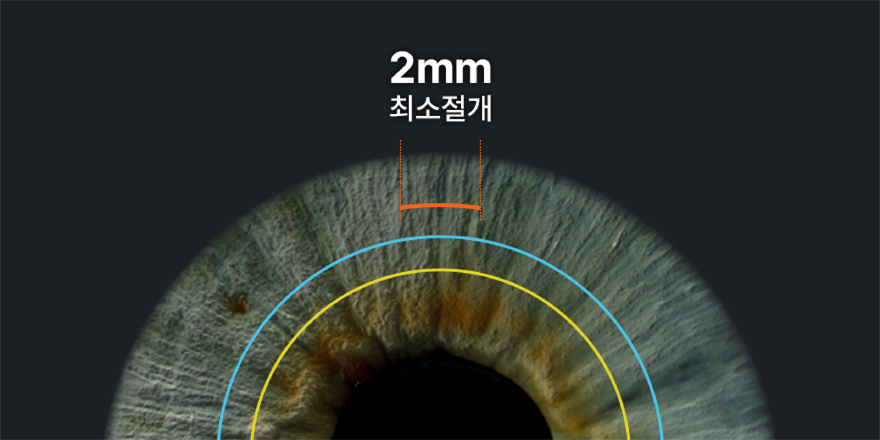 스마일라식 약 2mm 각막 절개 범위